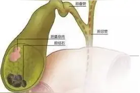 什么样的胆囊息肉样病变需要手术治疗图片