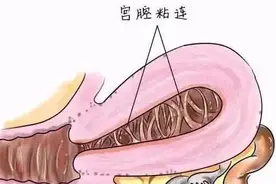 关爱女性｜呵护子宫，不可忽视“宫腔粘连”图片