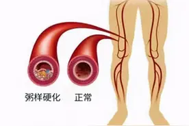糖尿病下肢动脉病变，肢端麻凉疼，这种情况如何用药才正确？图片