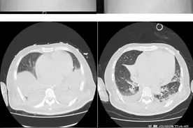 命大！三明50岁男子脑梗还感染了超级病菌，居然和死神插肩而过，医生：死亡率超过40%图片