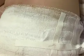 烫伤（浅二度个人恢复情况分享）图片