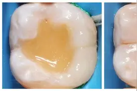 补牙“油水”有多大？如果想看牙省钱，请一字不落地看完图片