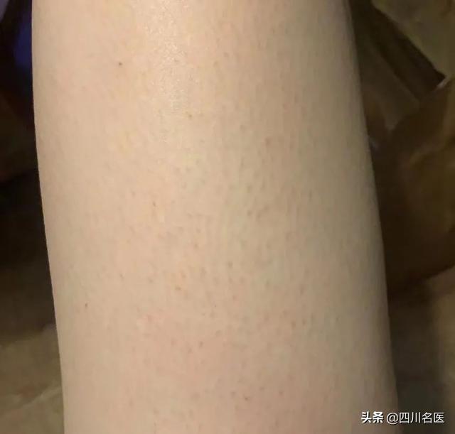 鸡皮肤真的不能消除吗