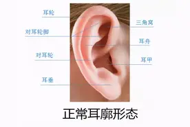 新生儿耳廓畸形，宝爸宝妈们常常忽视而错过了最佳治疗时间图片