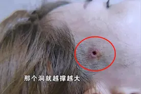 美容院老板娘做完“线雕”后，鬓角突然多了个洞？维权还困难重重图片