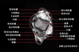 踝关节MRI解剖及7种常见损伤类型图片