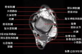 踝关节MRI解剖及7种常见损伤类型图片
