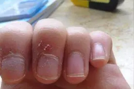 手上倒刺不要撕，中医教你1招搞定，消除倒刺，管用又省钱！