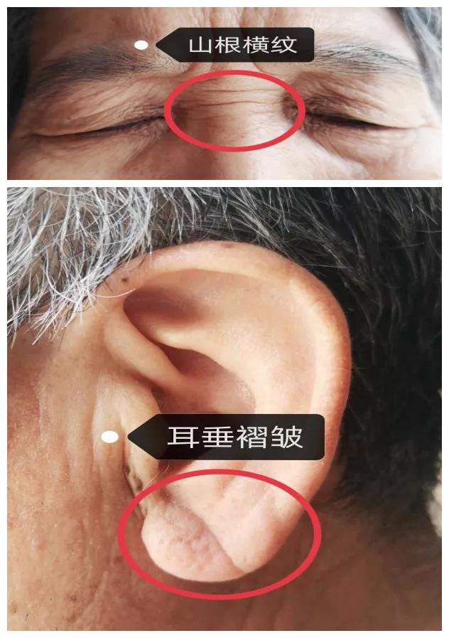 鼻梁上有横纹的人命理（鼻根有横纹）
