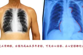 高血压心脏最特征的改变是左心室肥厚，肥厚好不好？可致心力衰竭图片