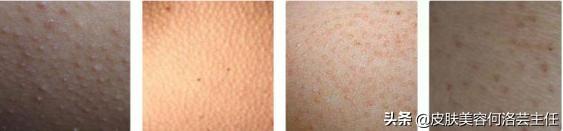 身上长鸡皮肤图片