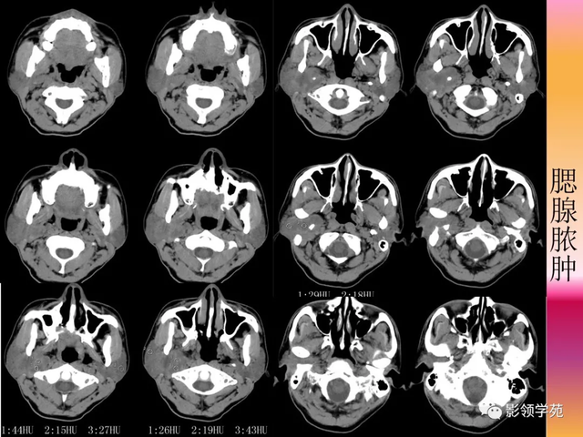 腮腺角化型鳞癌