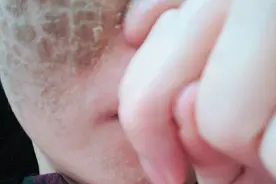 做了点阵激光后图片