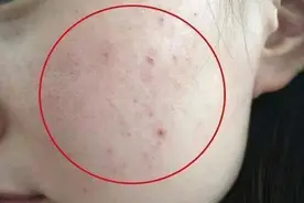 3元一块的硫磺皂洗脸去螨虫，省钱又方便？皮肤科医生不赞同图片