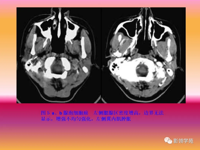 腮腺角化型鳞癌