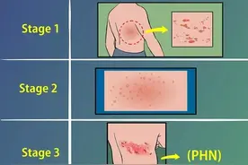 电一电，缓解带状疱疹痛图片