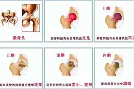 一张图片告诉你，股骨头坏死治疗为什么要恢复血运？图片
