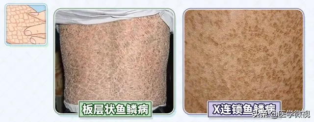 皮肤起皮屑像鱼鳞图片