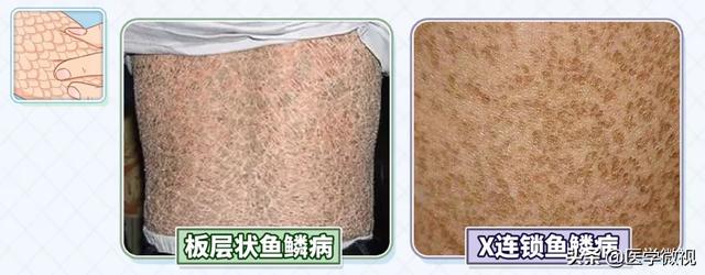 我的x性连锁鱼鳞病经历 我的x性连锁鱼鳞病经历