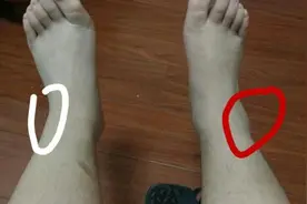 为什么老年人经常脚肿？告诉你真正原因，做到这几步远离水肿图片