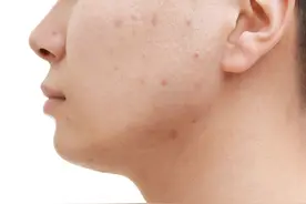 科普篇丨夏季戴口罩闷痘泛红？皮肤科专家教你 4步战“痘”大法图片