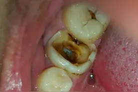 牙齿上的“黑线”是怎么回事？医生提醒：劝你不要用手抠图片