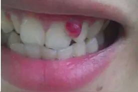 牙龈上长了个瘤子怎么办？不疼不痒会影响健康吗？听听牙医怎么说图片