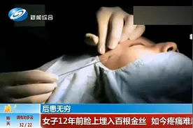 女子为更年轻，在脸上植入百根“金丝”，10多年后怎么样了？图片