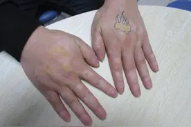 超市老板突患白癜风，医生表示跟长期酗酒有直接关系图片