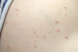 银屑病治疗中皮损变大是病情加重了吗图片