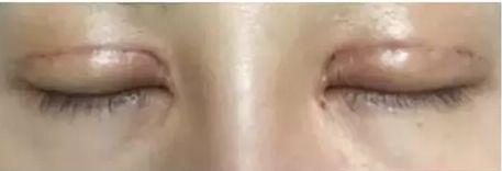 脂溢性角化做激光会留疤痕吗