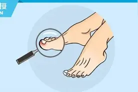 痛得钻心的甲沟炎，竟是这些不良习惯造成的...图片