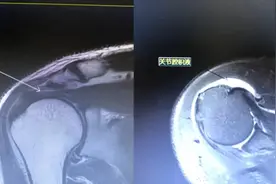 精准治疗！超声引导下液压松解治疗肩周炎图片