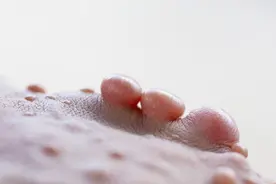 神经纤维瘤病的致病基因一般有两种！医生为你详细说明！视频封面