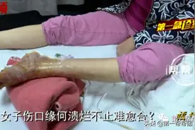 女子受伤之后，伤口溃烂不止无法愈合，每天都在绝望边缘图片