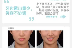 厦门牙齿矫正｜隐形正畸｜调整牙齿露出量，改善前牙微笑美学图片