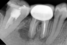 拍牙片也分类型，了解这些牙片类型，看牙不怕被坑钱图片