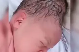 产妇分娩时不懂正确用力，婴儿头部被严重挤压，网友：很像寿星公图片