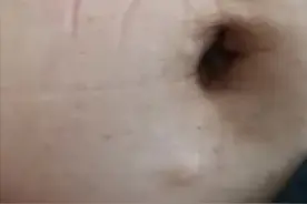 叫了N年的皮脂腺囊肿，原来是个误会图片