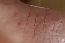 脚后跟干裂脱皮怎么办？1个土方子，5个妙招，脚后跟再也不开裂了图片