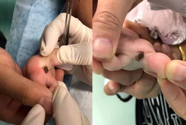像被蜱虫叮咬就要格外引起重视,因为蜱虫很容易钻到肉里,并且假如用