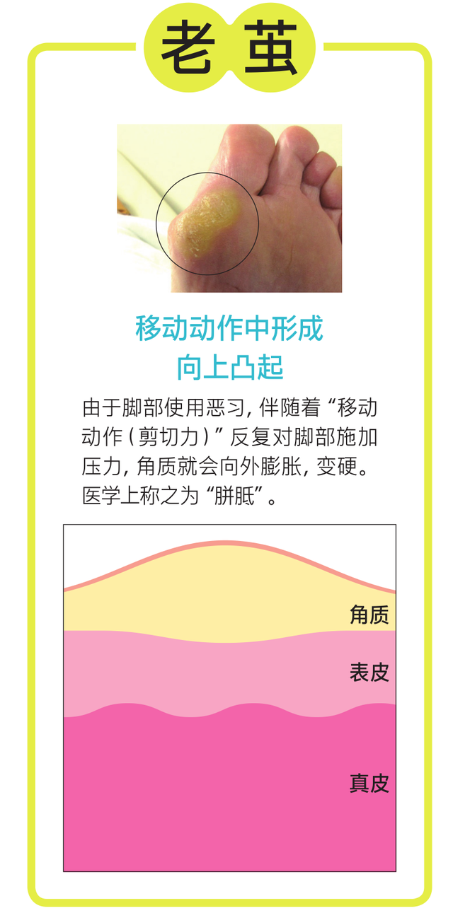 角化过度型足癣脂肪肝
