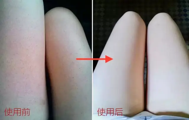 鸡皮肤治疗神器