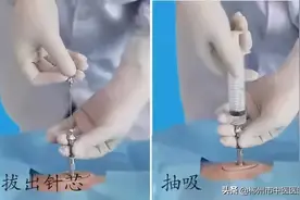 骨髓穿刺是怎么回事？对身体伤害大吗？图片