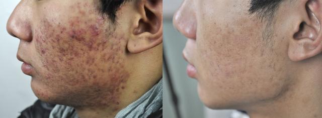 什么是痤疮疤痕『痤疮瘢痕的四种分型』 - 卓润号