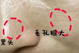 毛孔多大才算粗大？知道毛孔粗大的根源吗？很多人却只知道找医美图片