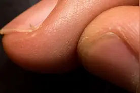 疼疼疼！甲沟炎的“幕后黑手”终于找到了！有这些习惯的赶紧改图片