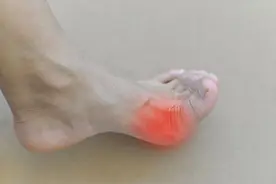 患上痛风时，脚部会有4种表现，若你有，要及时降尿酸了图片