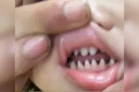 女童张口的一瞬间令人诧异，牙齿像“鲨鱼牙”，网友：父母惹的祸图片