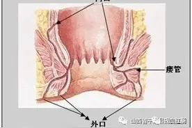 肛瘘难受吗？发现肛瘘怎么办？图片